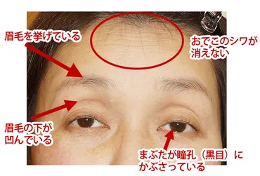 高齢者の眼瞼下垂、老け顔の原因になる眼瞼下垂