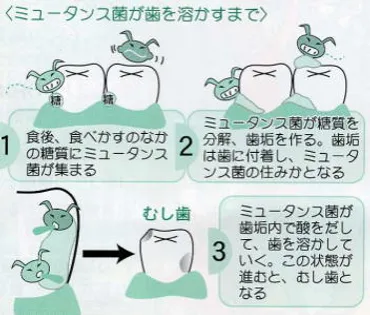 虫歯って実は怖い！？知らないと損する虫歯の真実虫歯の進行段階とは！？