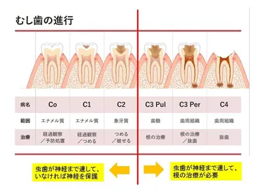 どこで虫歯の進行を食い止める！！？虫歯と根の治療について！！ 