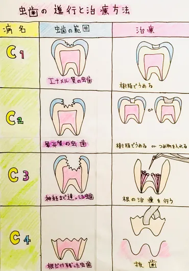 虫歯の進行と治療方法 