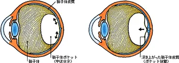 No.20. 黄斑円孔・黄斑前膜 