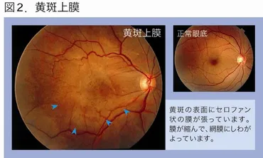 黄斑円孔・黄斑上膜（網膜前膜）について