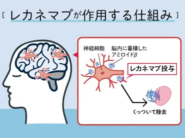 国内でも承認 アルツハイマー病の新薬「レカネマブ」を徹底解説 