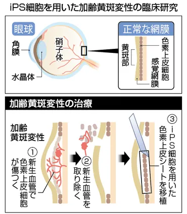 加齢黄斑変性の情報 